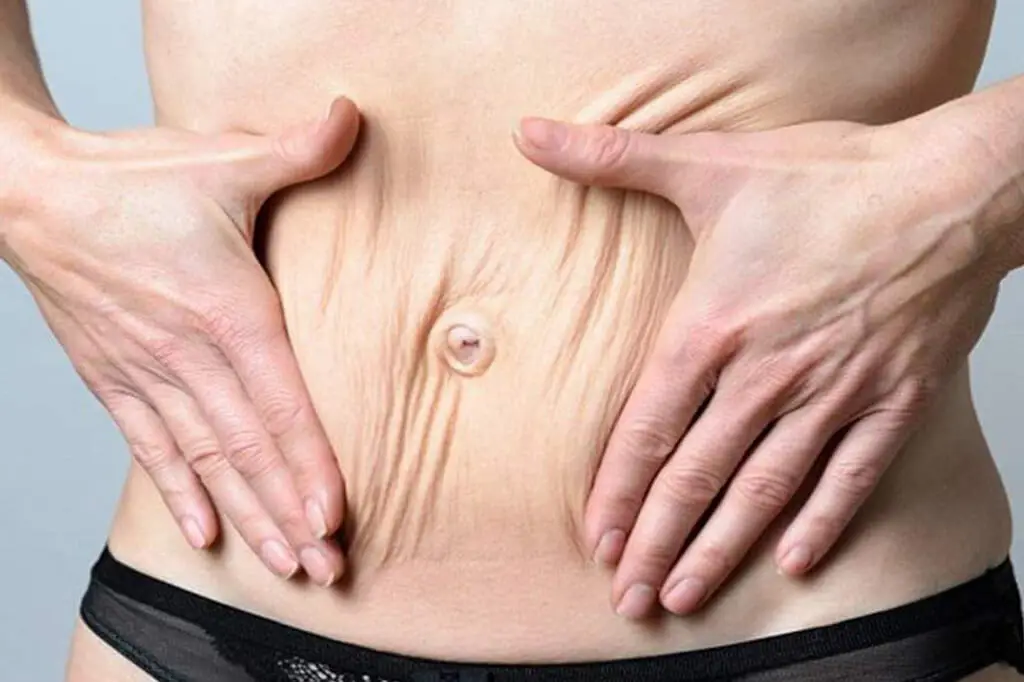 flacidez-tissular-atelierbeleza.pt